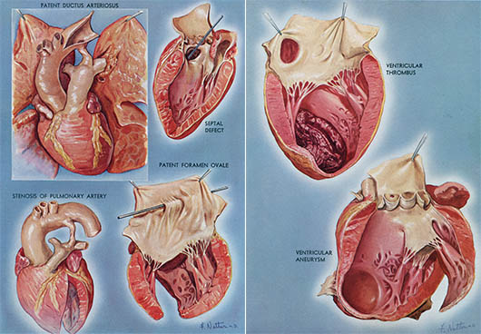 Heart Disease, click for larger image